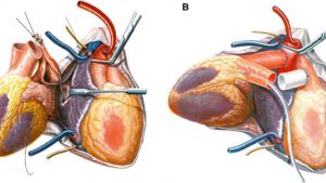 پیوند قلب