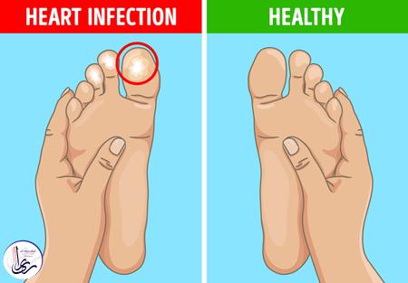 توده های دردناک در انگشتان پا